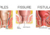 Difference between Piles, Fissures, and Fistula