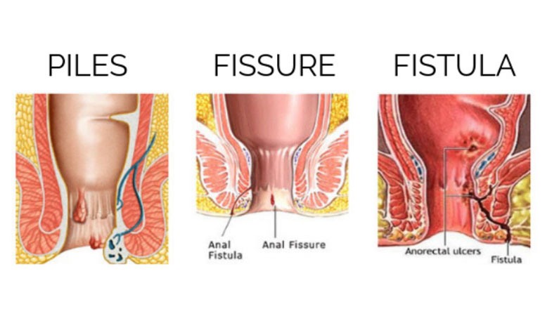 Difference between Piles, Fissures, and Fistula