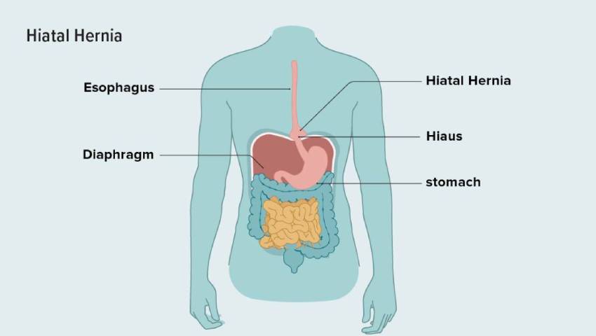 Hiatal Hernia Treatment