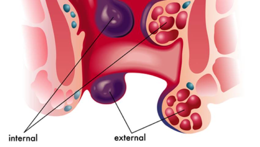 Piles Treatment