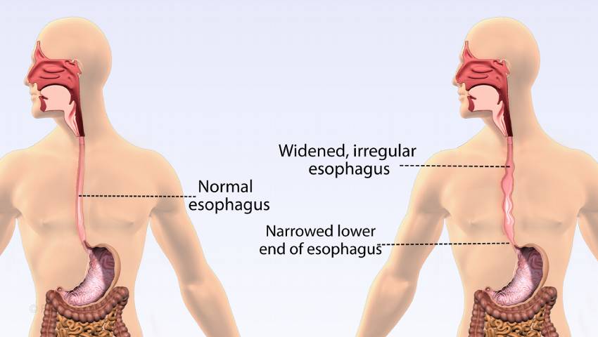 Achalasia Treatment