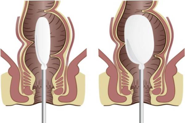 Anorectal Manometry in Pune