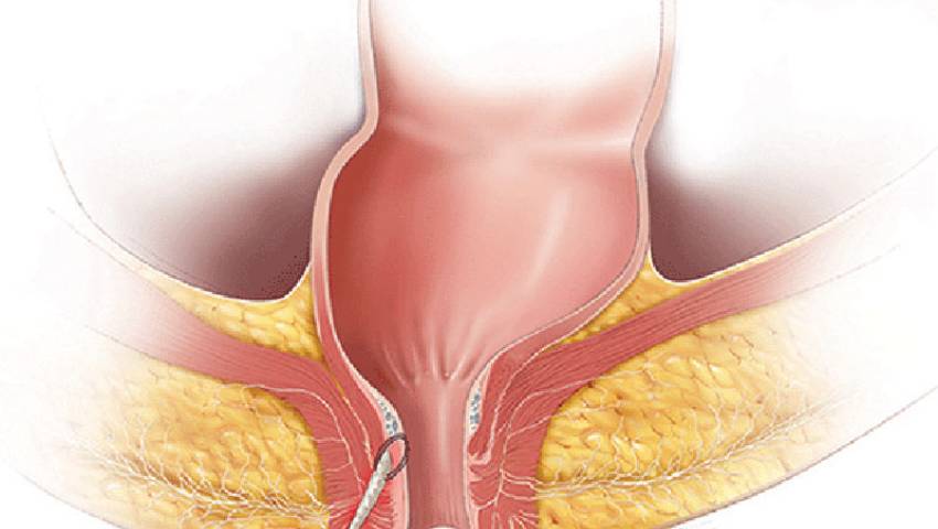 Fistula Surgery