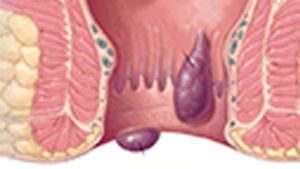 Piles Rypes Types of Piles (Haemorrhoids): All 4 Grades Explained with Pictures ...