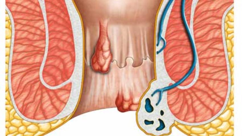 Fistula in Ano