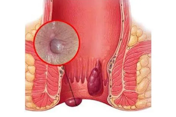 Thrombosed Piles