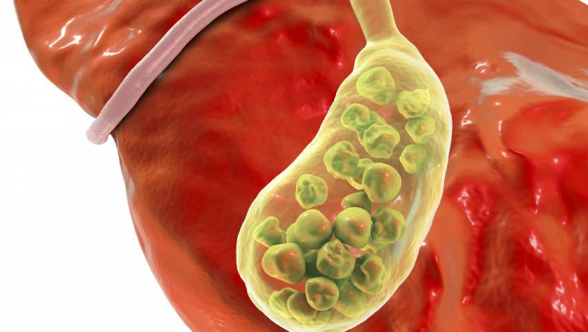 Symptoms of Gallbladder Disease