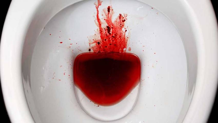 Blood in Stool