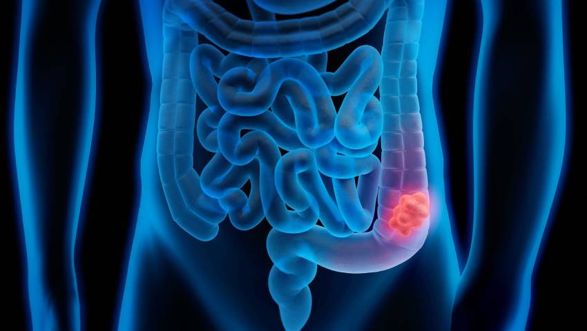 Colorectal Cancer Risk Factors