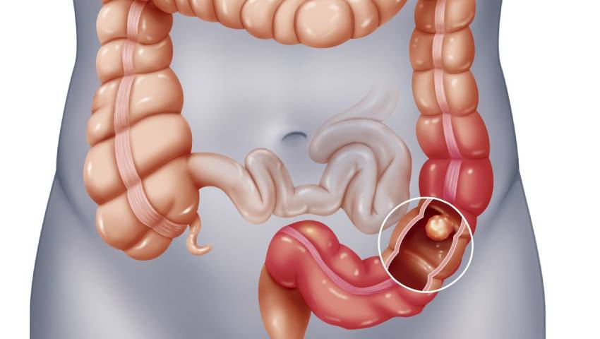 Bowel Obstruction