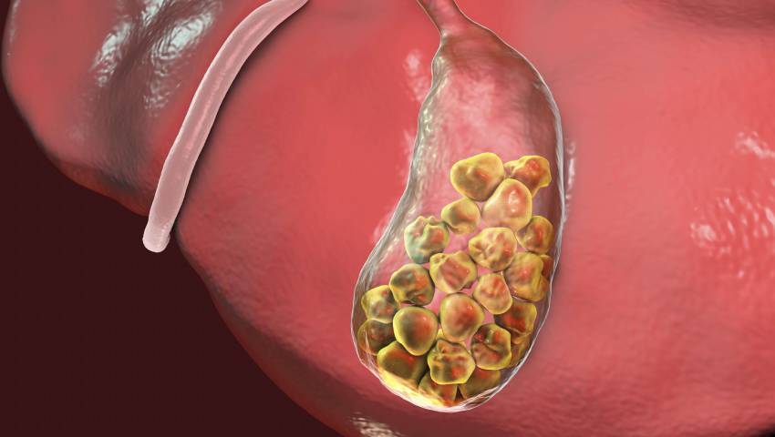 Gallstones