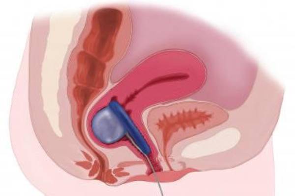 Fecal Incontinence Treatment