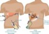Laparoscopic vs. Open Surgery for Gallstones: Which One Is Better?
