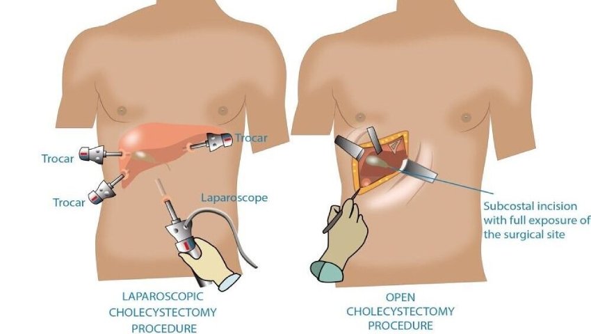 Laparoscopic vs. Open Surgery for Gallstones: Which One Is Better?