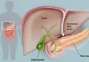 Common Gallbladder Problems and Their Symptoms