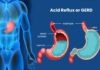 Medical diagram explaining acid reflux (GERD) and when surgery may be needed due to weakened lower esophageal sphincter