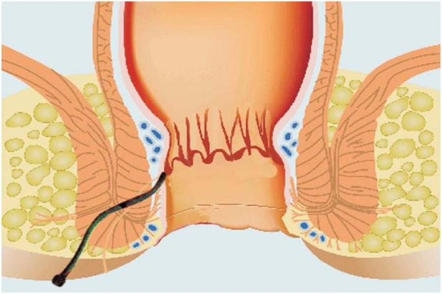 Fistula Specialist in Lonavala near Khandala and Talegaon Dabhade – Dr. Samrat Jankar