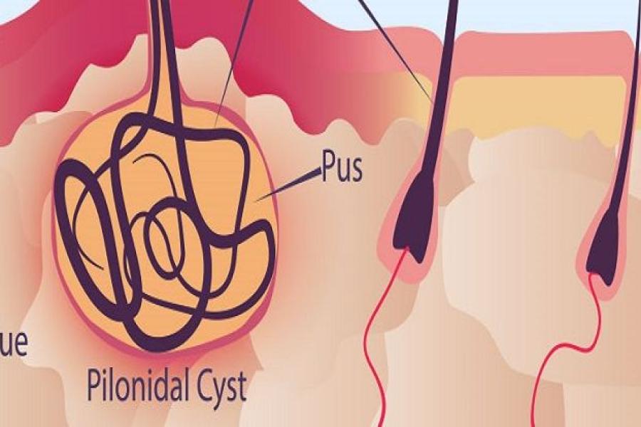 Advanced Pilonidal Sinus Treatment in Pune by Dr. Samrat Jankar using laser surgery