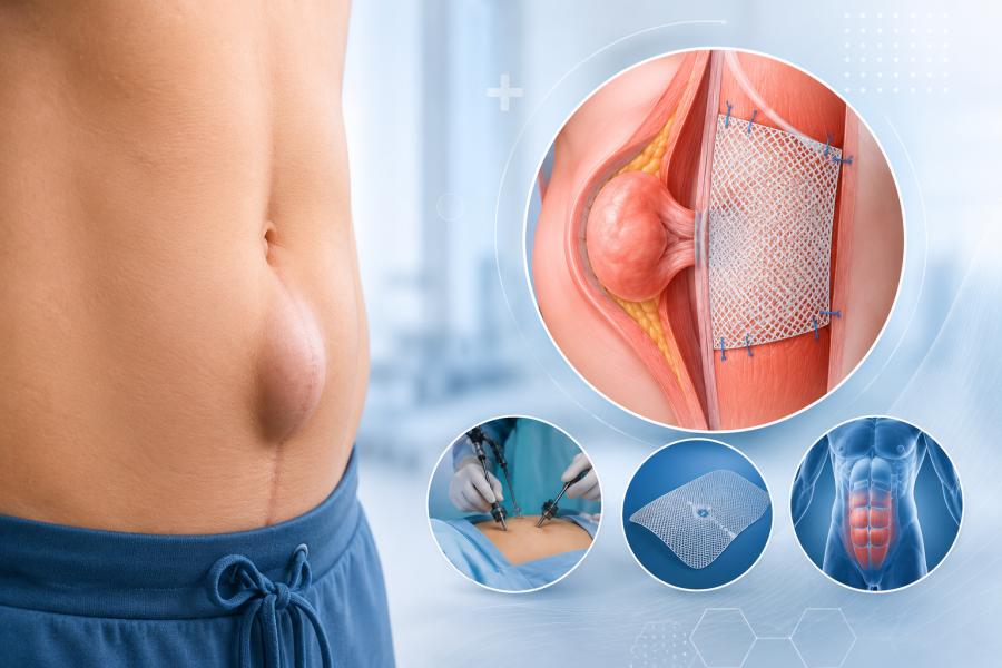 Ventral Hernia Treatment in Pune by Dr. Samrat Jankar
