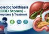 Choledocholithiasis CBD stones treatment by Dr Samrat Jankar GI Surgeon Pune