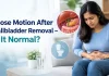 Loose Motion After Gallbladder Removal: Causes and Digestive Changes